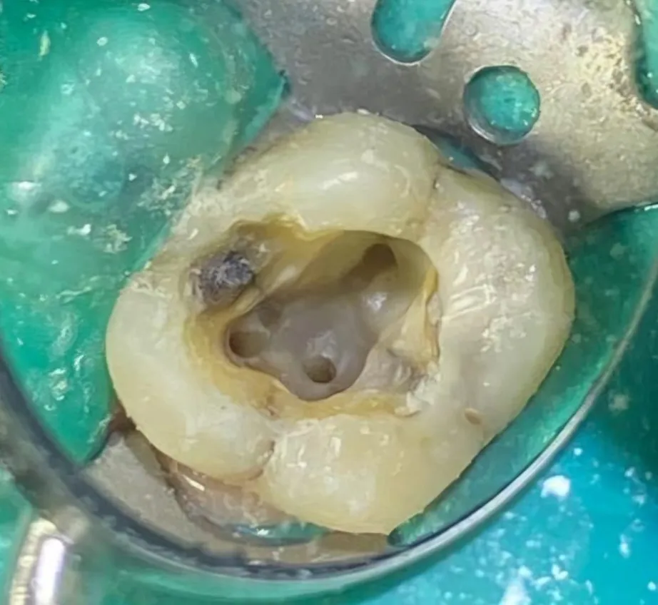 Tratamiento de conducto de dientes complejos