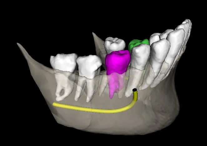 Evaluación de dientes con indicación de extracción
